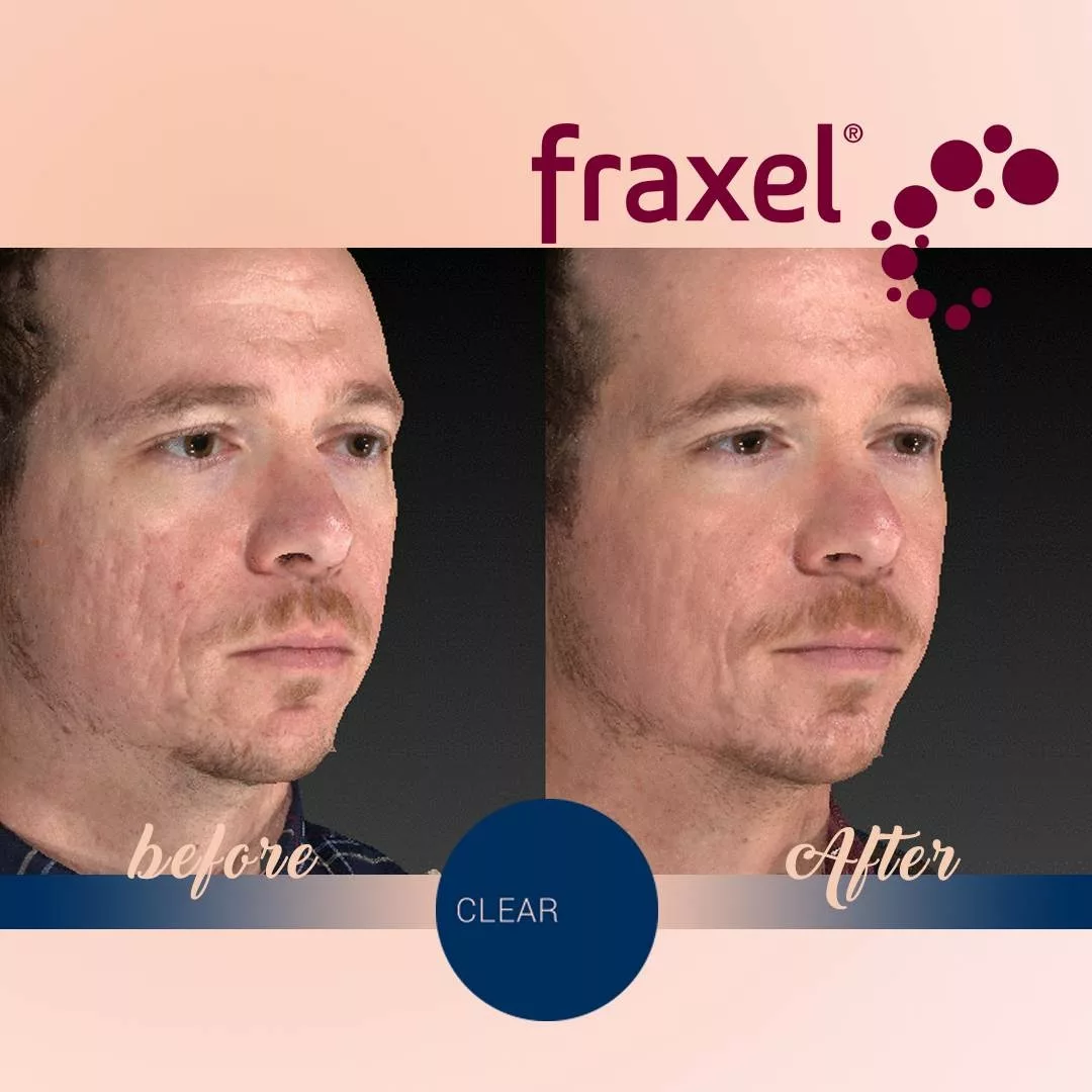 Here’s What Your Skin Looks Like After Fraxel Treatments - Laser Clinic